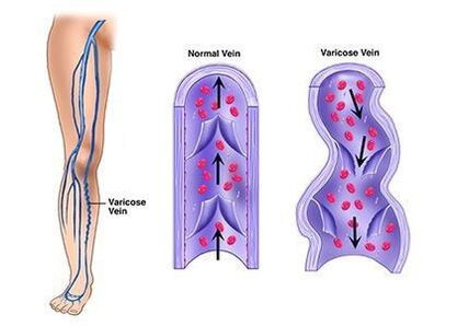 Neoveris impide o desenvolvemento de patoloxías venosas