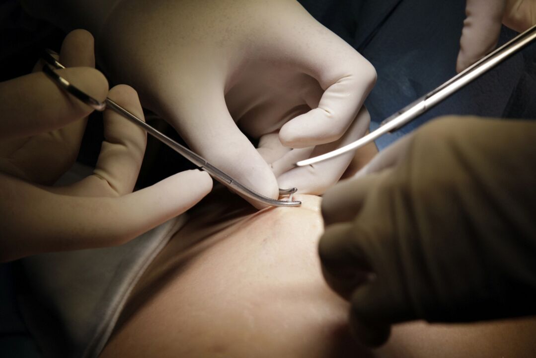 Intervención cirúrxica
