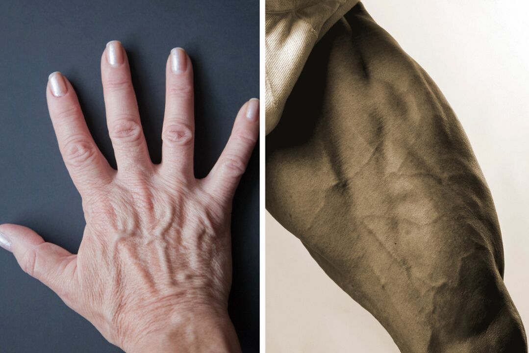 Síntomas de varices