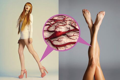 Varices nas pernas