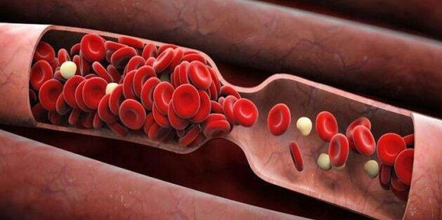 Prevención de coágulos de sangue