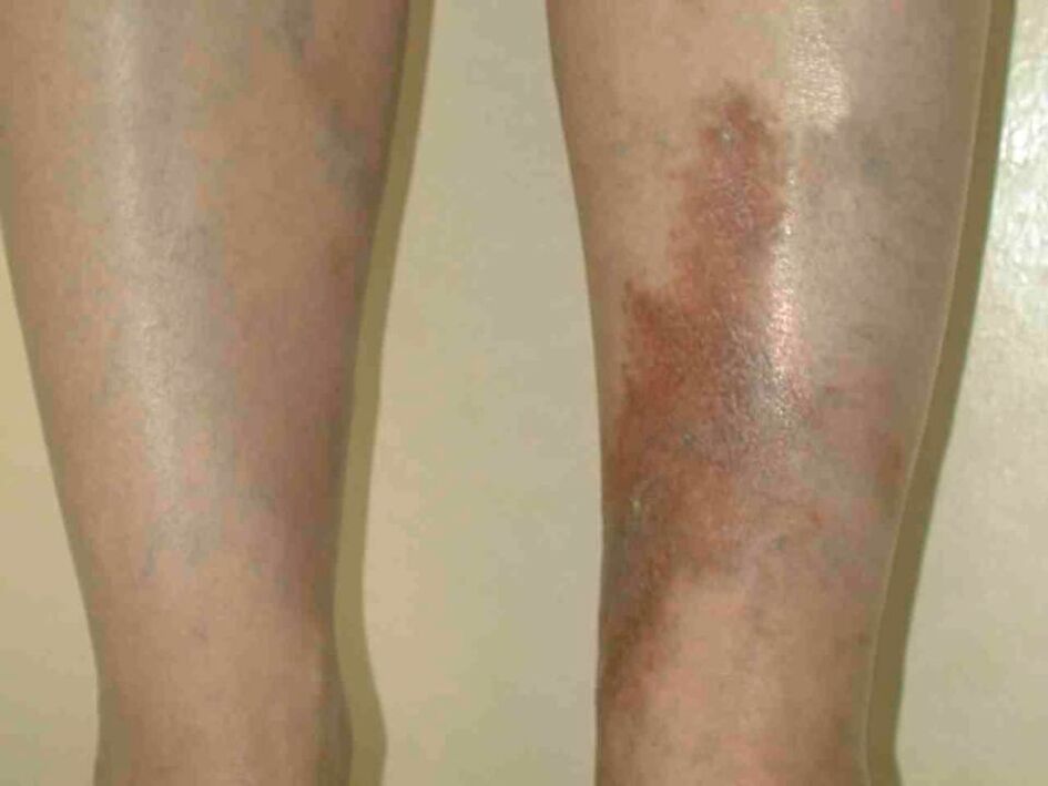Etapas de varices