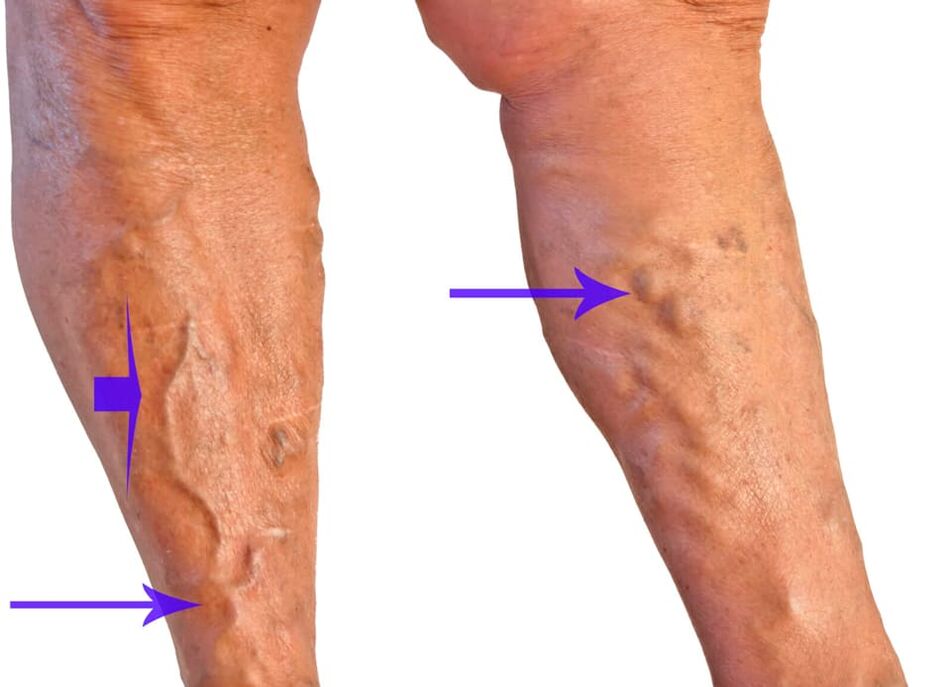 nodos varices