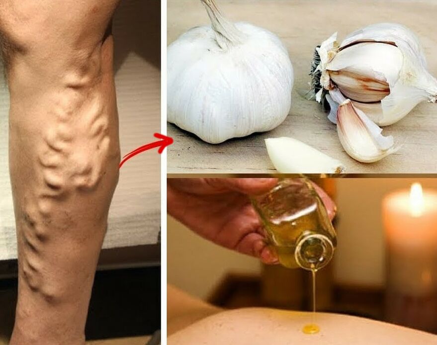 Medicamentos para varices