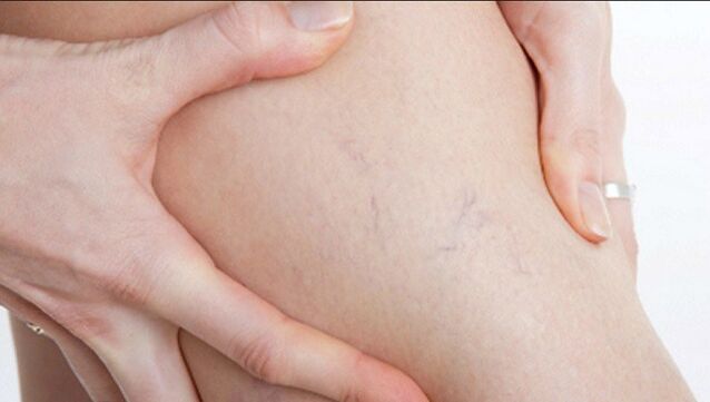 As arañas nas pernas son un sinal de varices