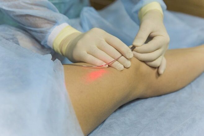 Tratamento con láser de varices