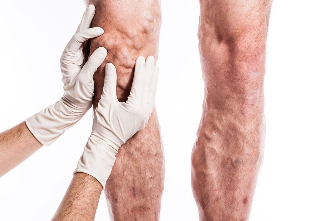 O flebólogo examina as pernas dun paciente con varices