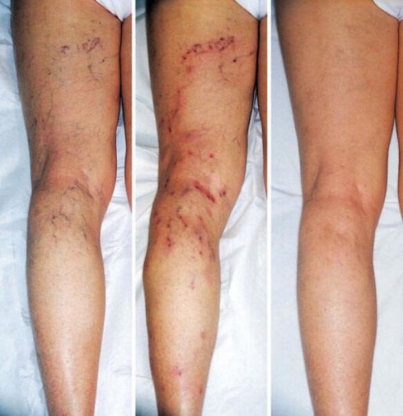 fases de varices das extremidades inferiores