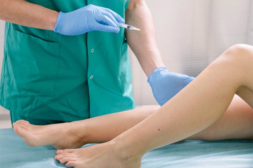 escleroterapia para a eliminación de varices