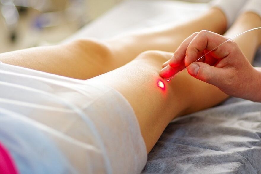 tratamento con láser para varices