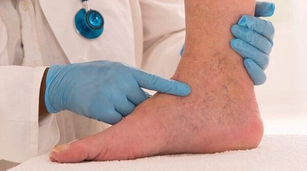 médico examinando as pernas con varices