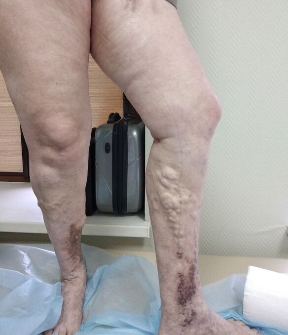 pernas con varices