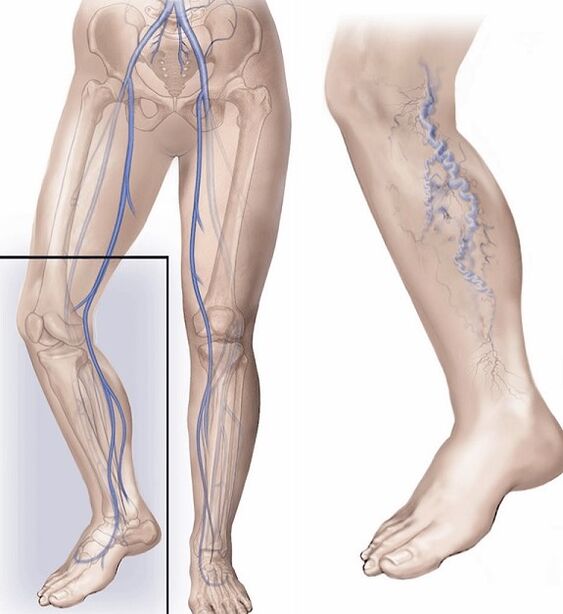 veas saudables e veas afectadas por varices