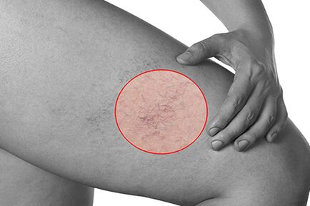 Telangiectasia en varices das extremidades inferiores